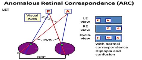 binocular rivalry test|abnormal retinal correspondence.